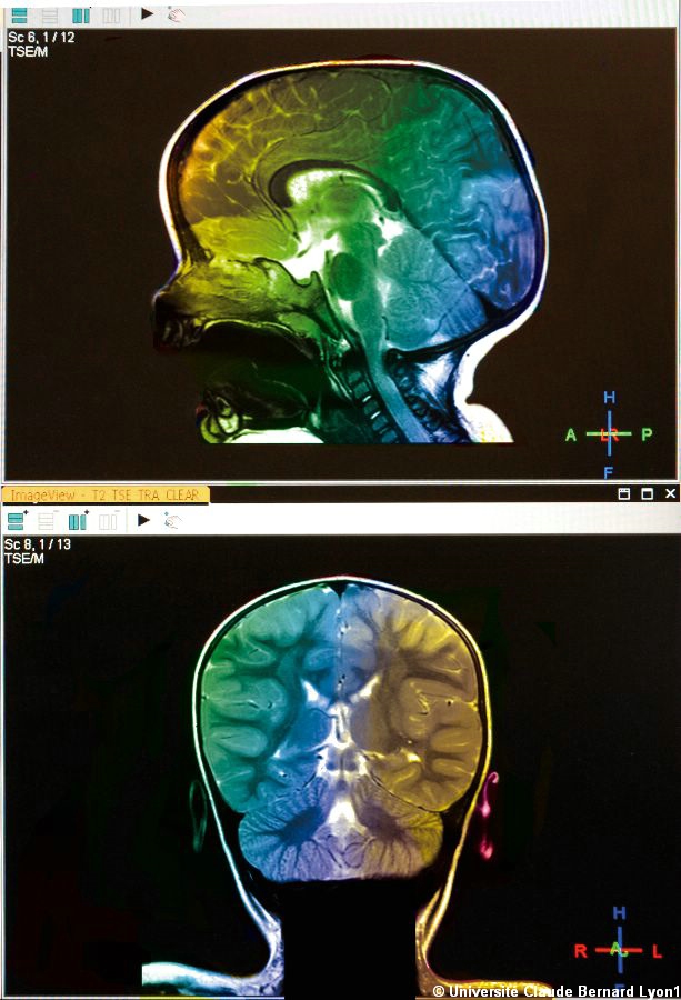 Photothèque Lyon 1 - IRM cérébrale colorisée
